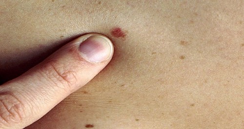 12 Common Cancer Symptoms That You Should Never Ignore Page 8